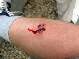 dog bite puncture wound to leg